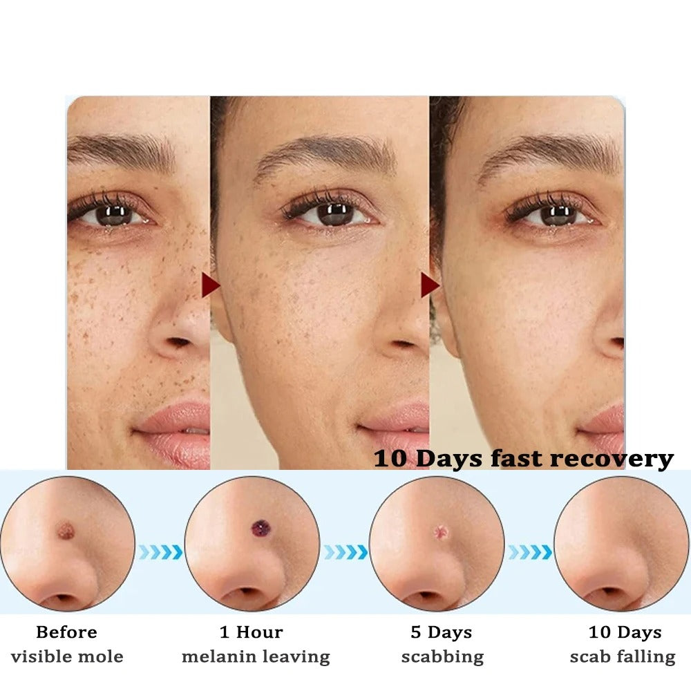 DermaClear Skin Tag Remover